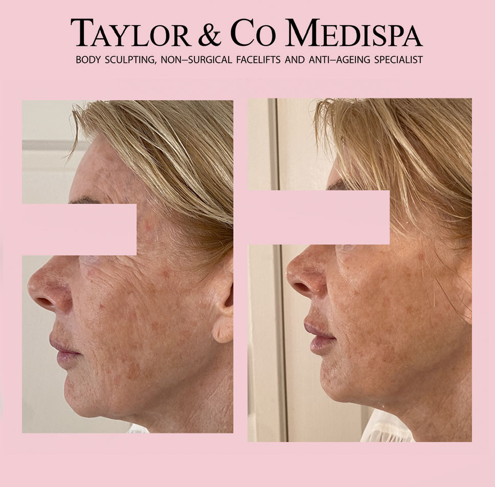 HIFU pamper package Taylor and Co Medispa Spa